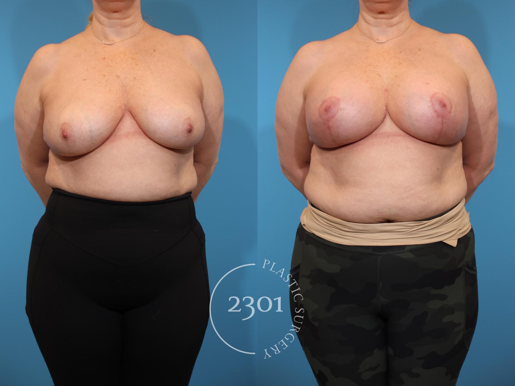 Before & After Mastopexy & Augmentation Case 940 Front View in Fort Worth, Plano, & Frisco, Texas