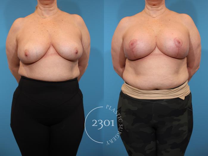 Before & After Mastopexy & Augmentation Case 940 Front View in Fort Worth, Plano, & Frisco, Texas