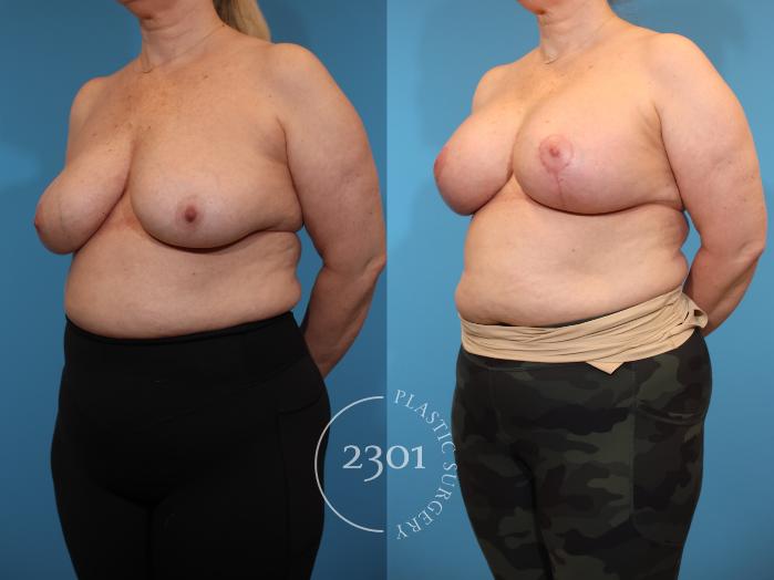 Before & After Mastopexy & Augmentation Case 940 Left Oblique View in Fort Worth, Plano, & Frisco, Texas