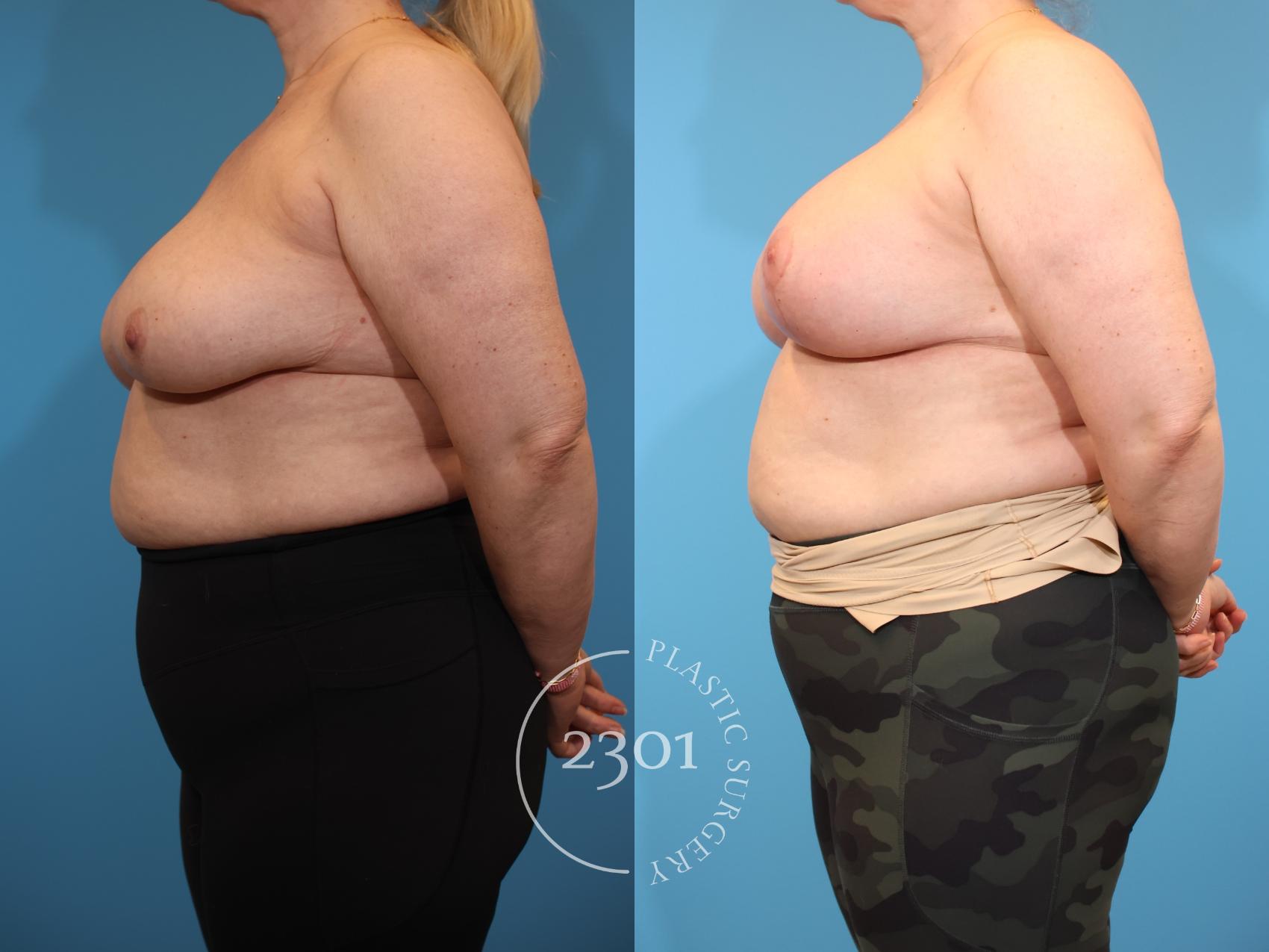Before & After Mastopexy & Augmentation Case 940 Left Side View in Fort Worth, Plano, & Frisco, Texas