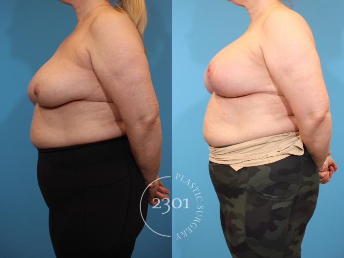 Before & After Mastopexy & Augmentation Case 940 Left Side View in Fort Worth, Plano, & Frisco, Texas