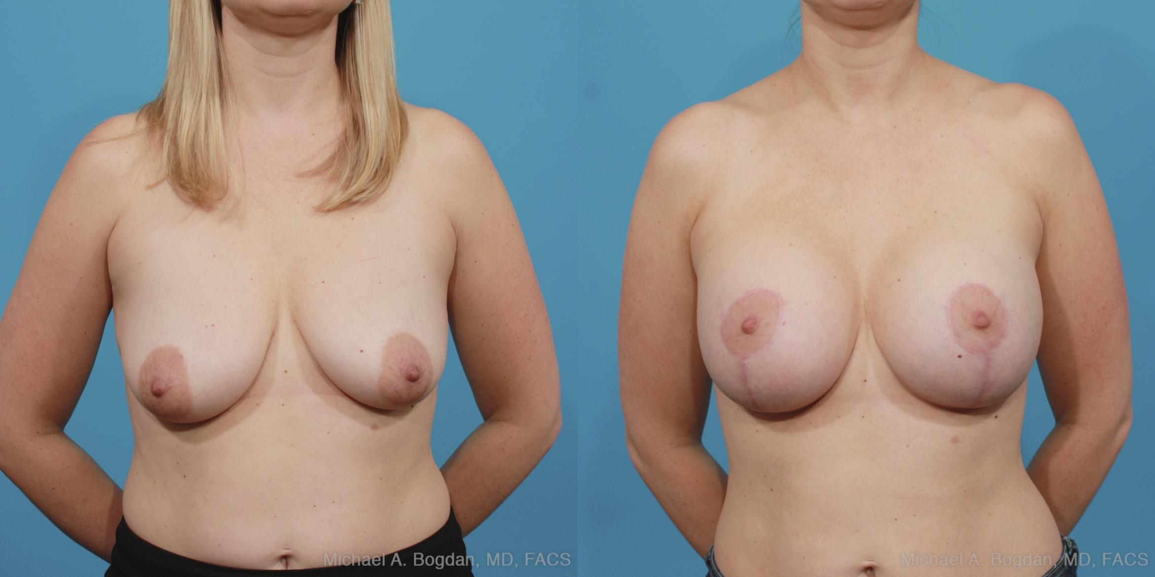 Before & After Mastopexy & Augmentation Case 404 View #1 View in Fort Worth & Frisco, Texas