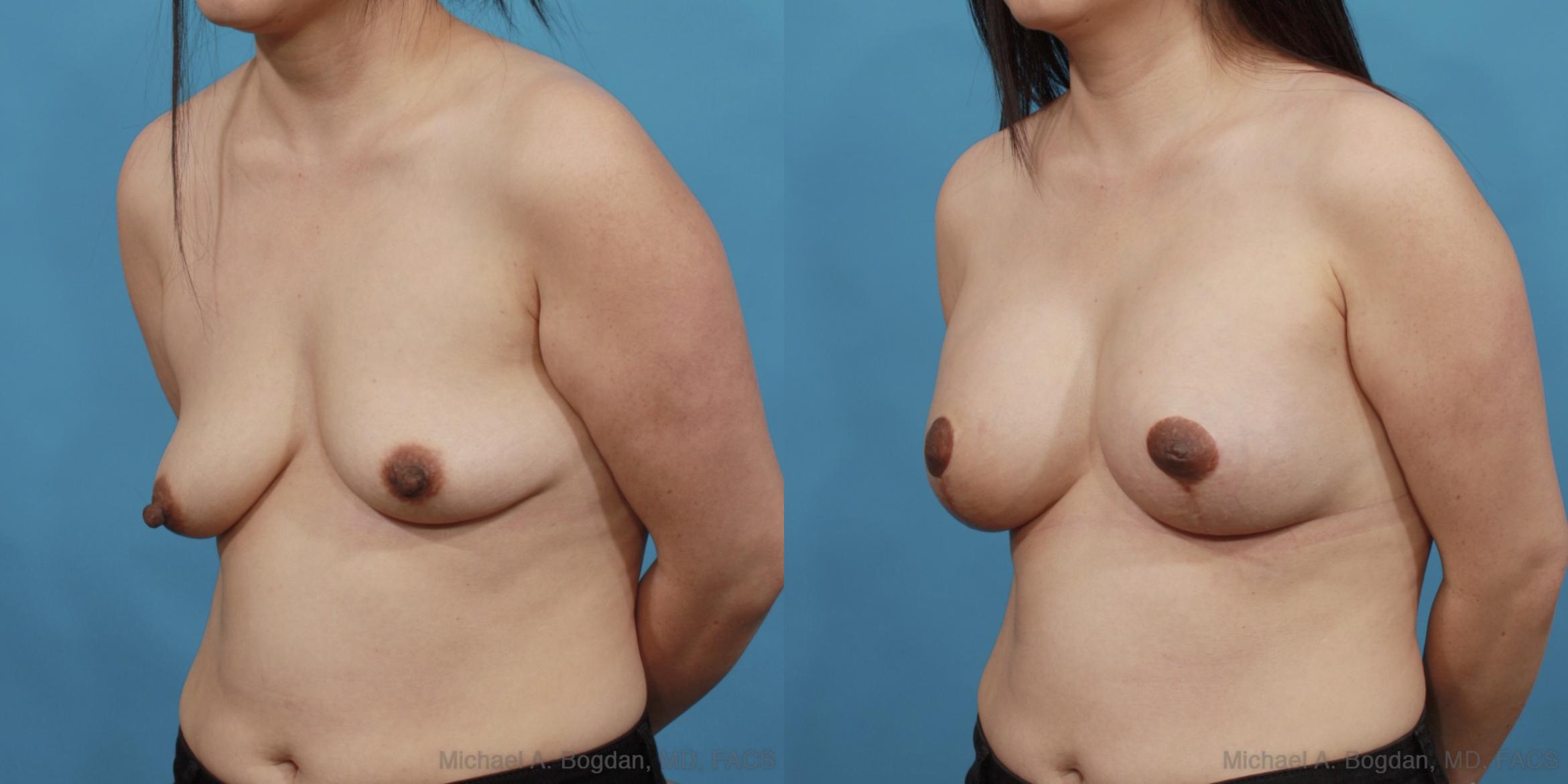 Before & After Mastopexy & Augmentation Case 537 View #2 View in Fort Worth & Frisco, Texas