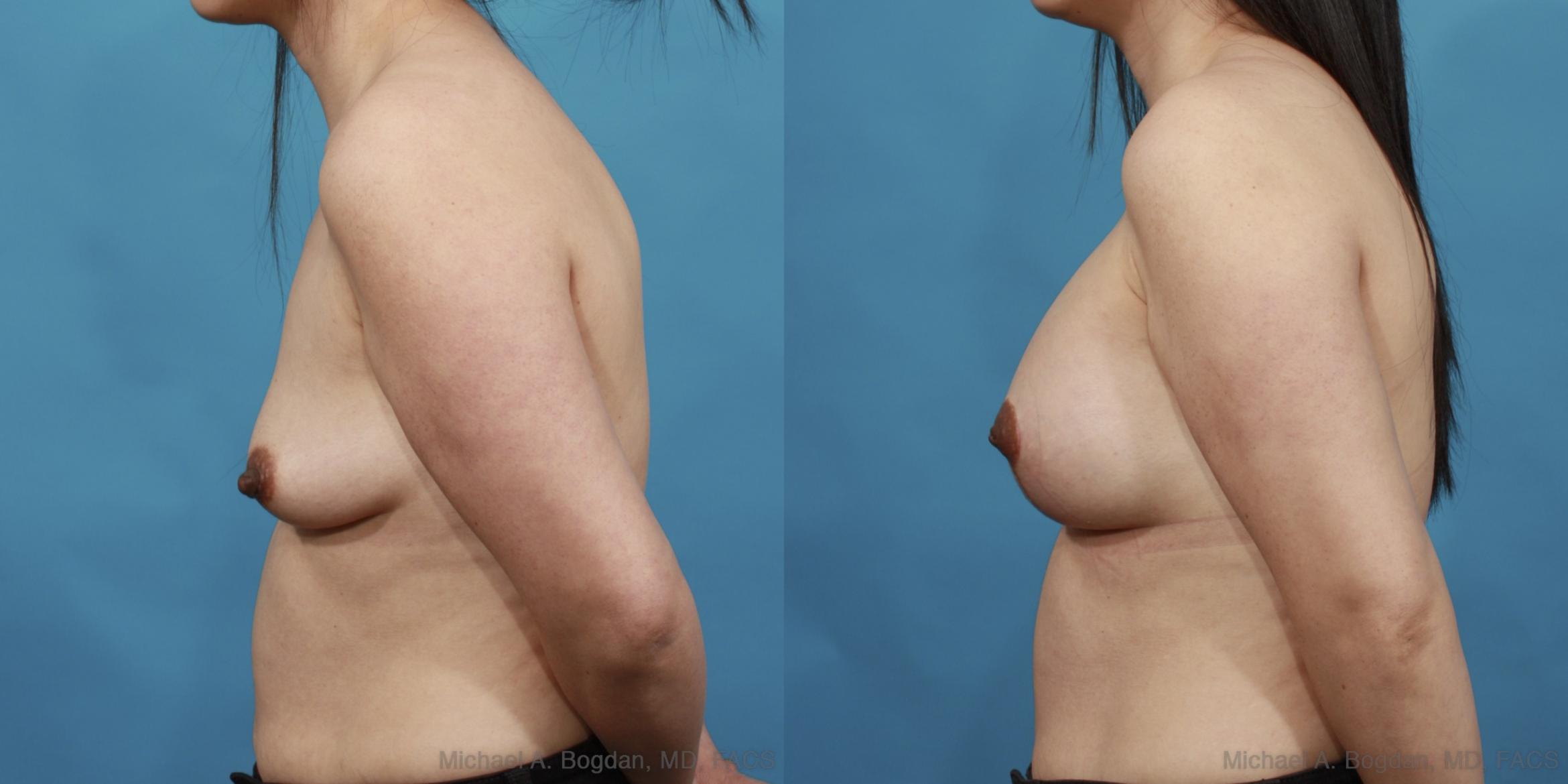 Before & After Mastopexy & Augmentation Case 537 View #3 View in Fort Worth & Frisco, Texas