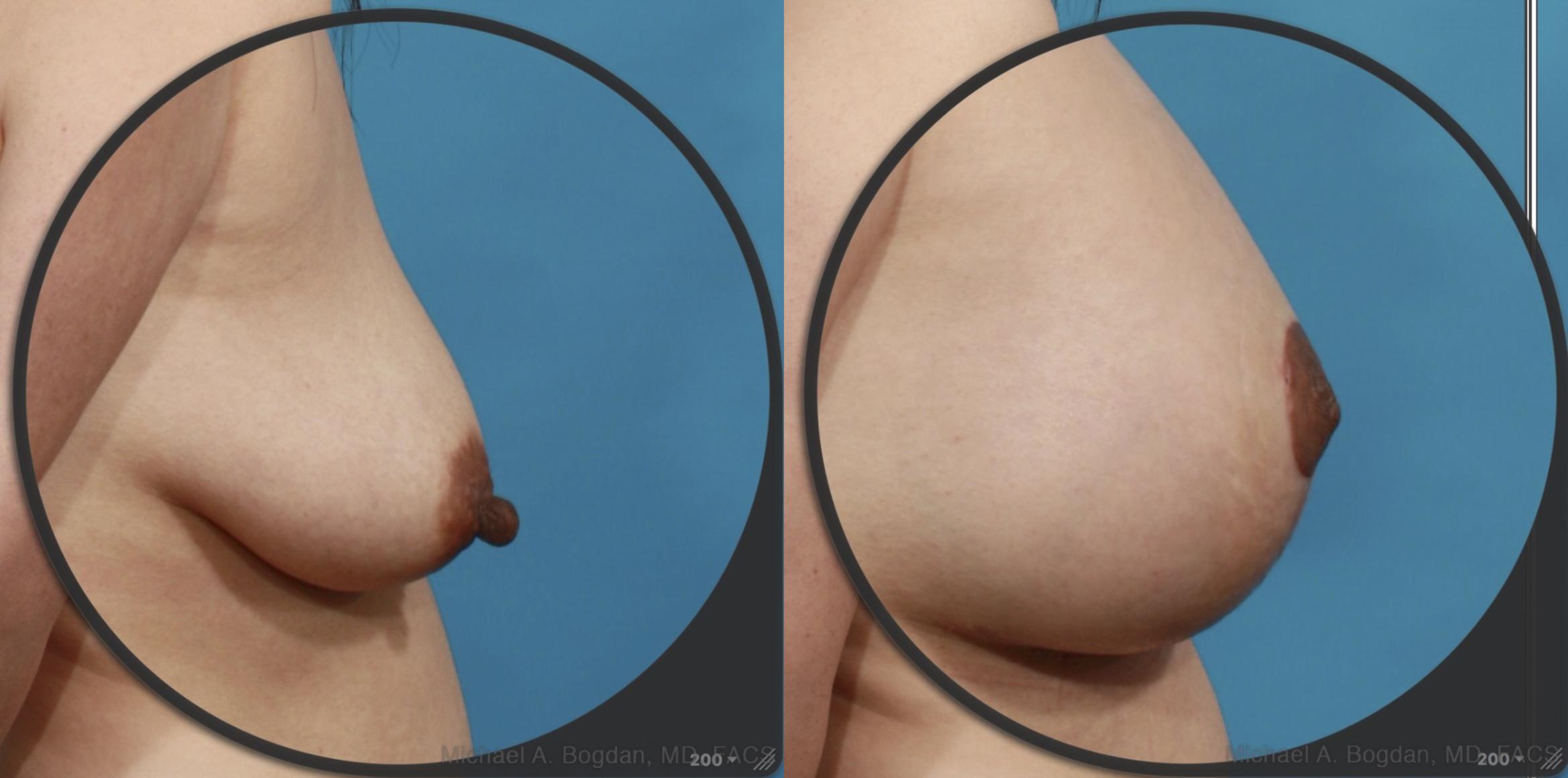 Before & After Mastopexy & Augmentation Case 537 View #4 View in Fort Worth & Frisco, Texas