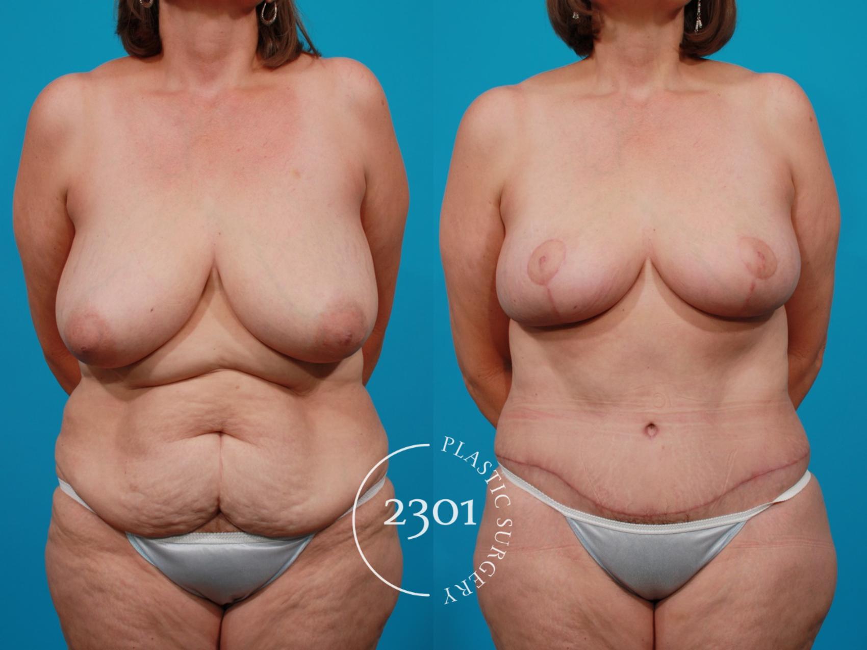 Before & After Breast Lift (Mastopexy) Case 104 View #1 View in Fort Worth, Plano, & Frisco, Texas