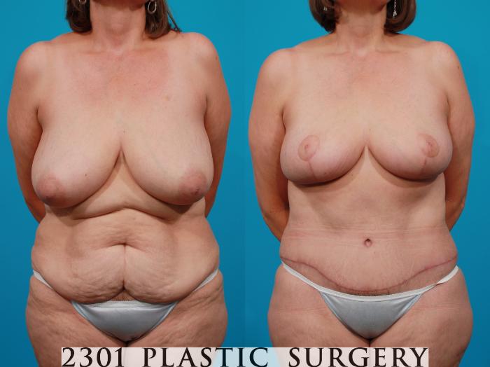 Before & After Breast Lift (Mastopexy) Case 104 View #1 View in Fort Worth, Plano, & Frisco, Texas