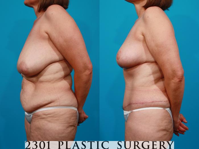 Before & After Breast Lift (Mastopexy) Case 104 View #2 View in Fort Worth, Plano, & Frisco, Texas