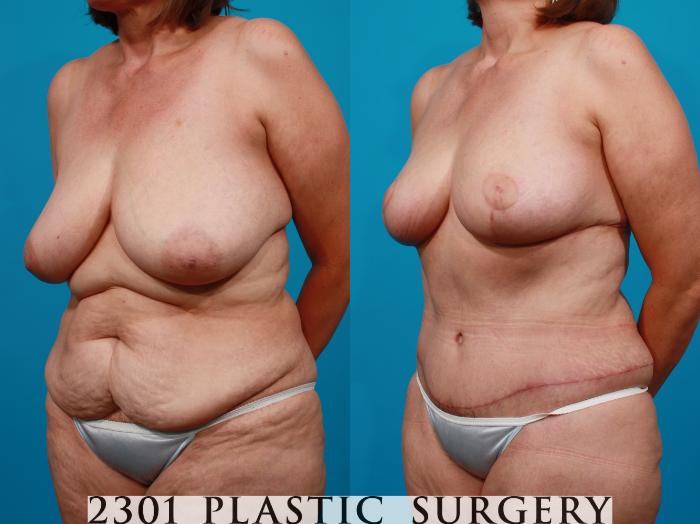 Before & After Breast Lift (Mastopexy) Case 104 View #3 View in Fort Worth, Plano, & Frisco, Texas