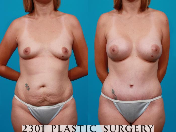 Before & After Silicone Implants Case 106 View #1 View in Fort Worth, Plano, & Frisco, Texas