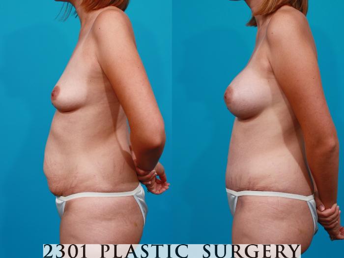 Before & After Tummy Tuck Case 106 View #2 View in Fort Worth, Plano, & Frisco, Texas