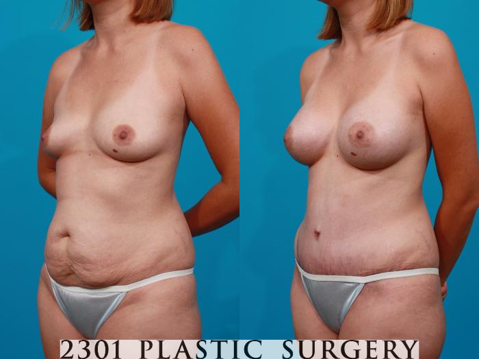 Before & After Silicone Implants Case 106 View #3 View in Fort Worth, Plano, & Frisco, Texas