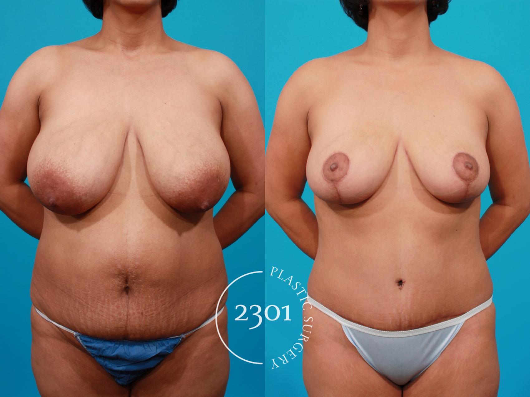 Before & After Breast Reduction Case 115 View #1 View in Fort Worth, Plano, & Frisco, Texas