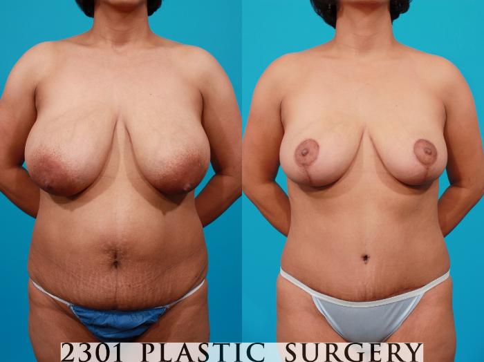 Before & After Breast Reduction Case 115 View #1 View in Fort Worth, Plano, & Frisco, Texas