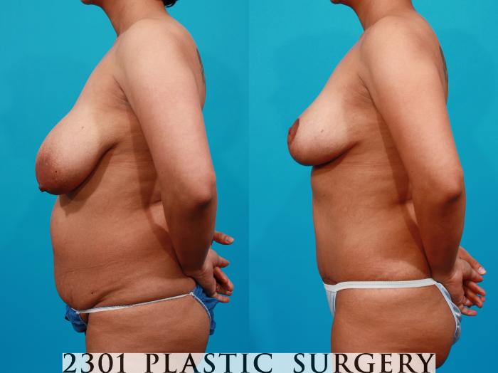 Before & After Breast Reduction Case 115 View #2 View in Fort Worth, Plano, & Frisco, Texas