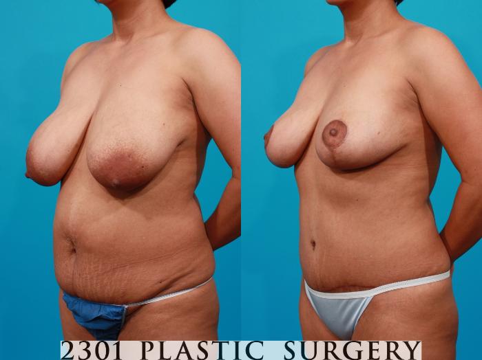Before & After Breast Reduction Case 115 View #3 View in Fort Worth, Plano, & Frisco, Texas