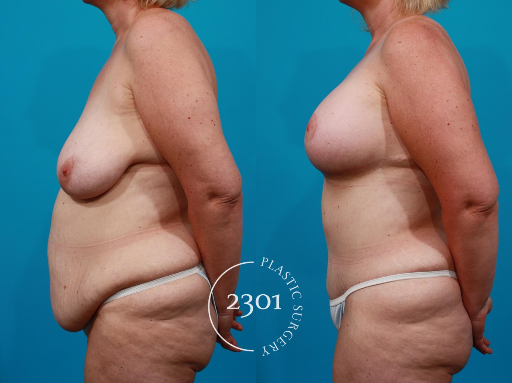 Before & After Silicone Implants Case 117 View #2 View in Fort Worth, Plano, & Frisco, Texas