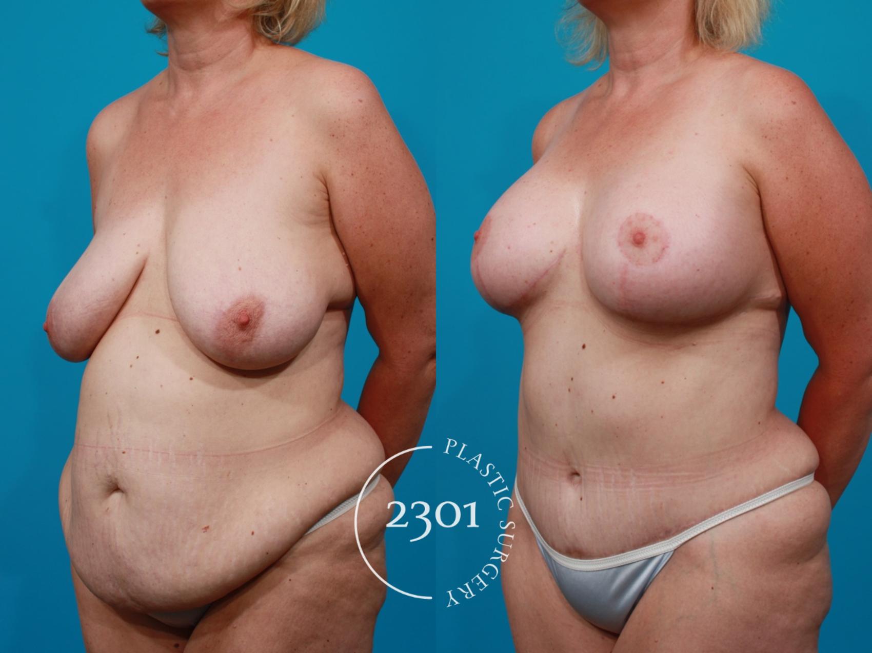 Before & After Silicone Implants Case 117 View #3 View in Fort Worth, Plano, & Frisco, Texas