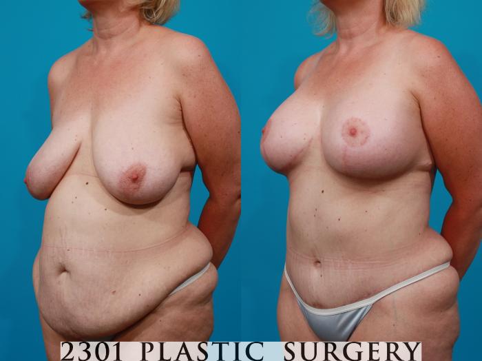 Before & After Mommy Makeover Case 117 View #3 View in Fort Worth, Plano, & Frisco, Texas