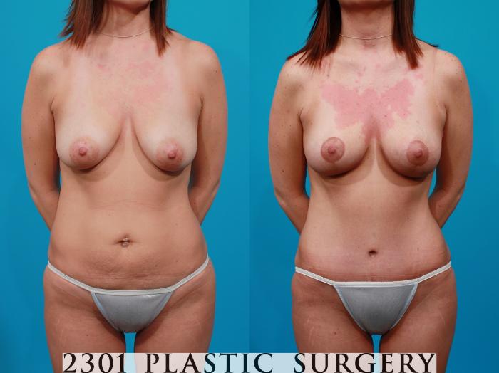 Before & After Tummy Tuck Case 125 View #1 View in Fort Worth, Plano, & Frisco, Texas