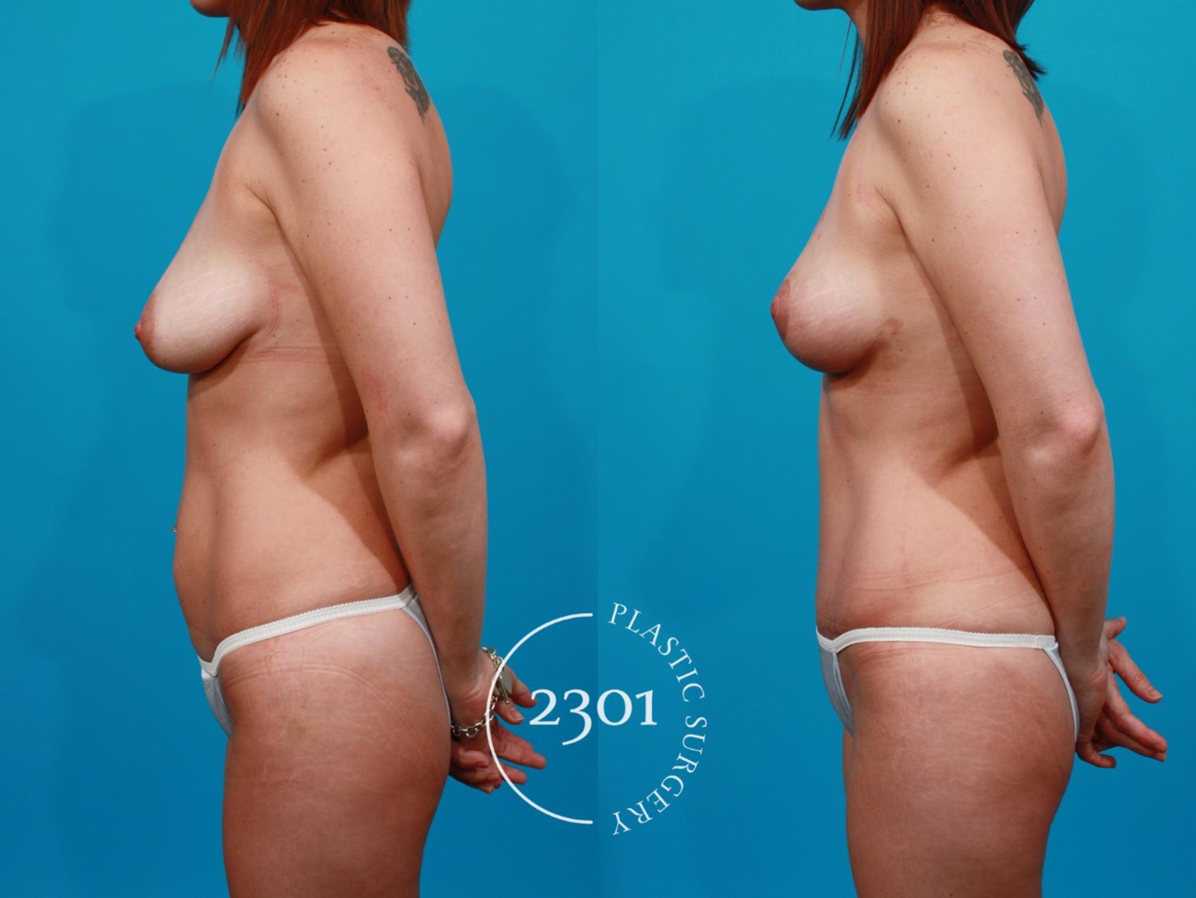 Before & After Mommy Makeover Case 125 View #2 View in Fort Worth, Plano, & Frisco, Texas