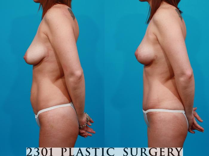 Before & After Breast Lift (Mastopexy) Case 125 View #2 View in Fort Worth, Plano, & Frisco, Texas