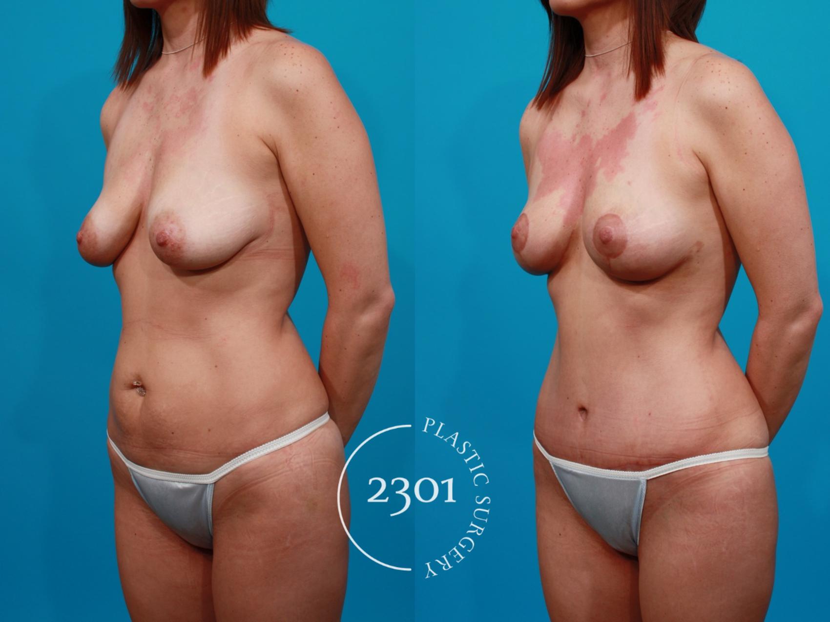 Before & After Mommy Makeover Case 125 View #3 View in Fort Worth, Plano, & Frisco, Texas