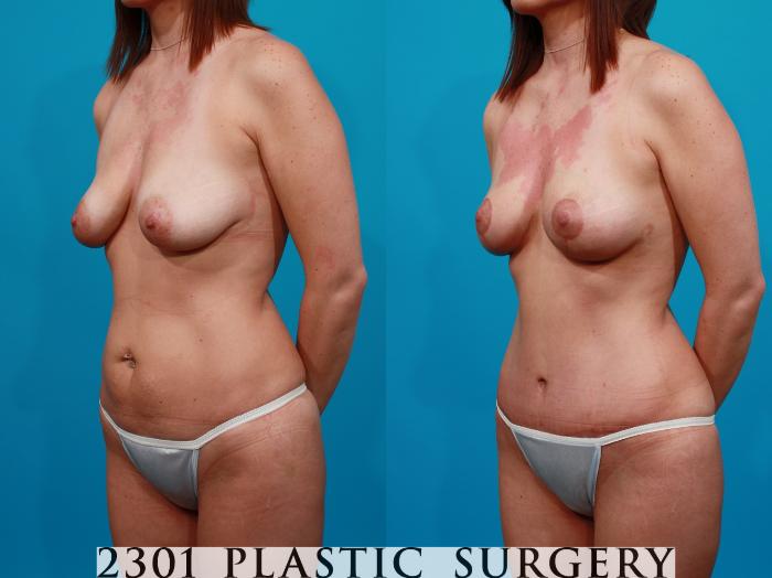 Before & After Breast Lift (Mastopexy) Case 125 View #3 View in Fort Worth, Plano, & Frisco, Texas