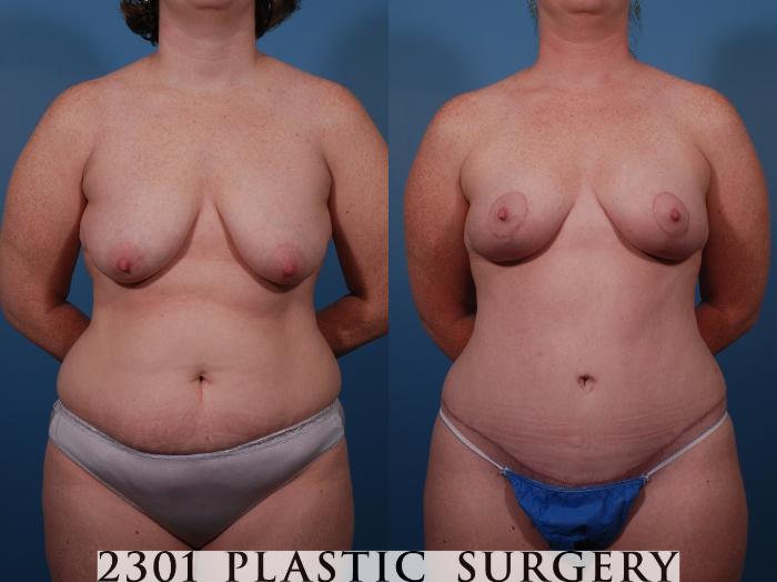 Before & After Breast Lift (Mastopexy) Case 135 View #1 View in Fort Worth, Plano, & Frisco, Texas