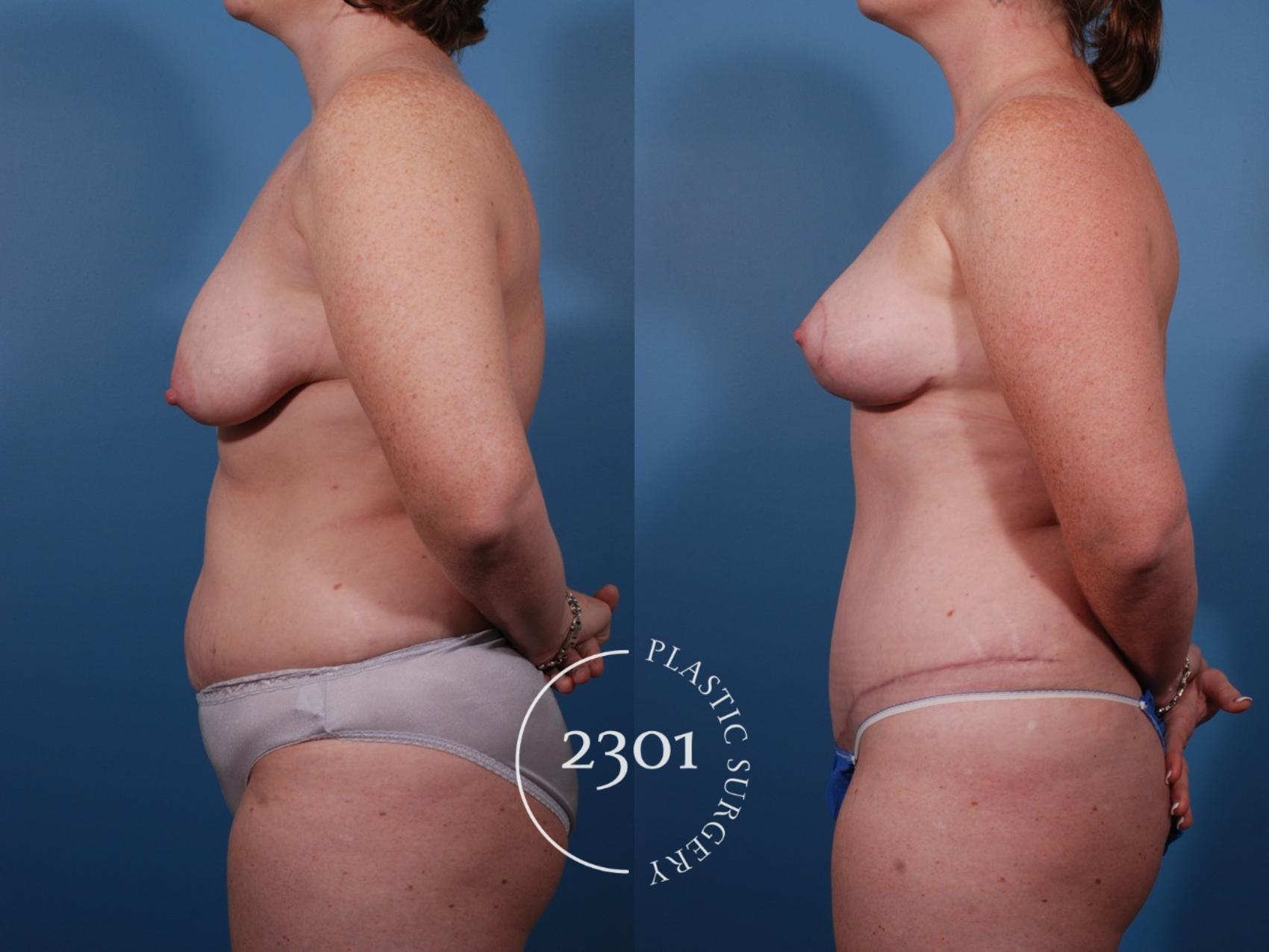 Before & After Mommy Makeover Case 135 View #2 View in Fort Worth, Plano, & Frisco, Texas