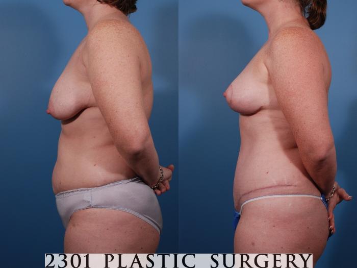 Before & After Breast Lift (Mastopexy) Case 135 View #2 View in Fort Worth, Plano, & Frisco, Texas