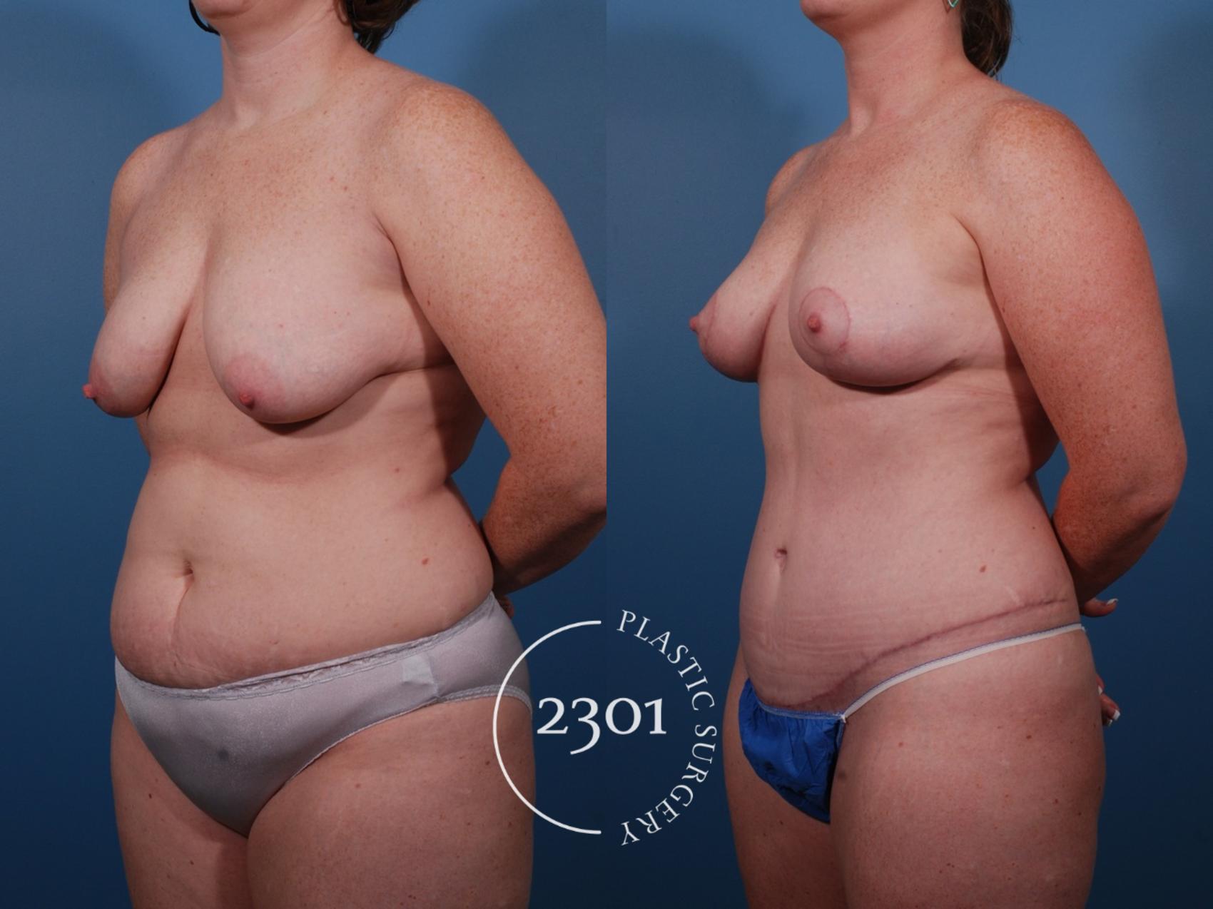 Before & After Mommy Makeover Case 135 View #3 View in Fort Worth, Plano, & Frisco, Texas