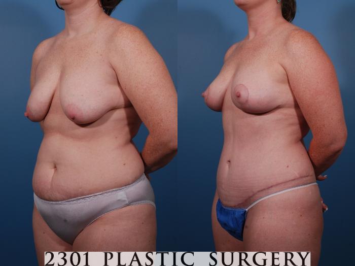 Before & After Breast Lift (Mastopexy) Case 135 View #3 View in Fort Worth, Plano, & Frisco, Texas