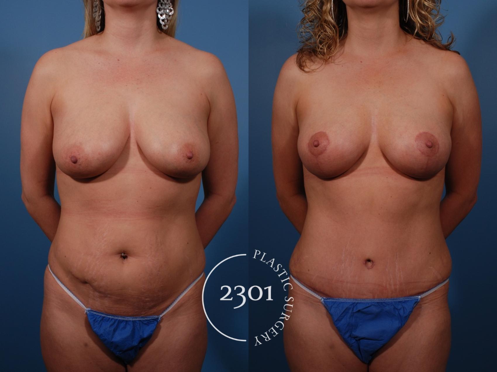 Before & After Tummy Tuck Case 136 View #1 View in Fort Worth, Plano, & Frisco, Texas