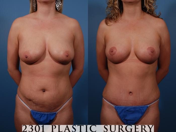 Before & After Tummy Tuck Case 136 View #1 View in Fort Worth, Plano, & Frisco, Texas