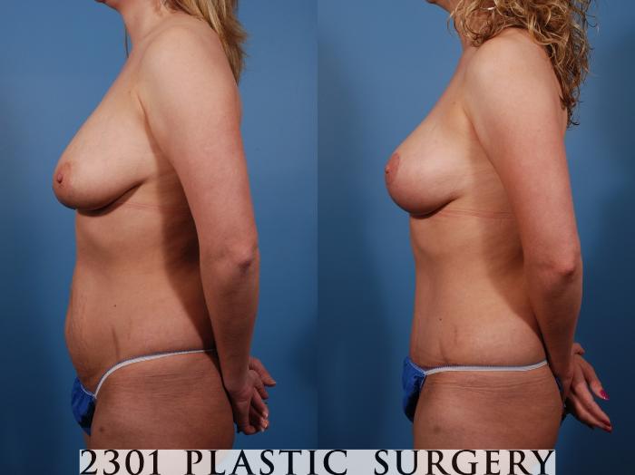 Before & After Tummy Tuck Case 136 View #2 View in Fort Worth, Plano, & Frisco, Texas