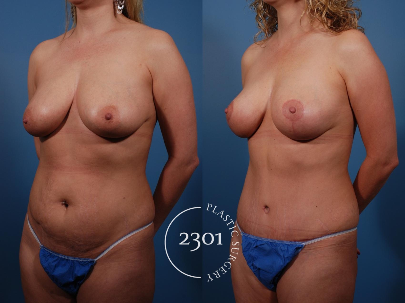 Before & After Mommy Makeover Case 136 View #3 View in Fort Worth, Plano, & Frisco, Texas
