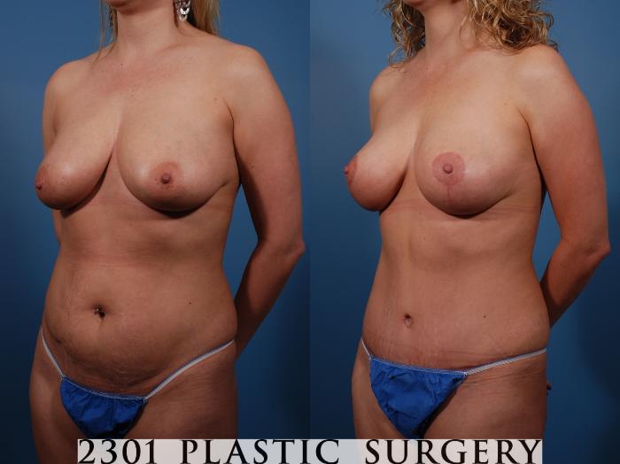 Before & After Tummy Tuck Case 136 View #3 View in Fort Worth, Plano, & Frisco, Texas