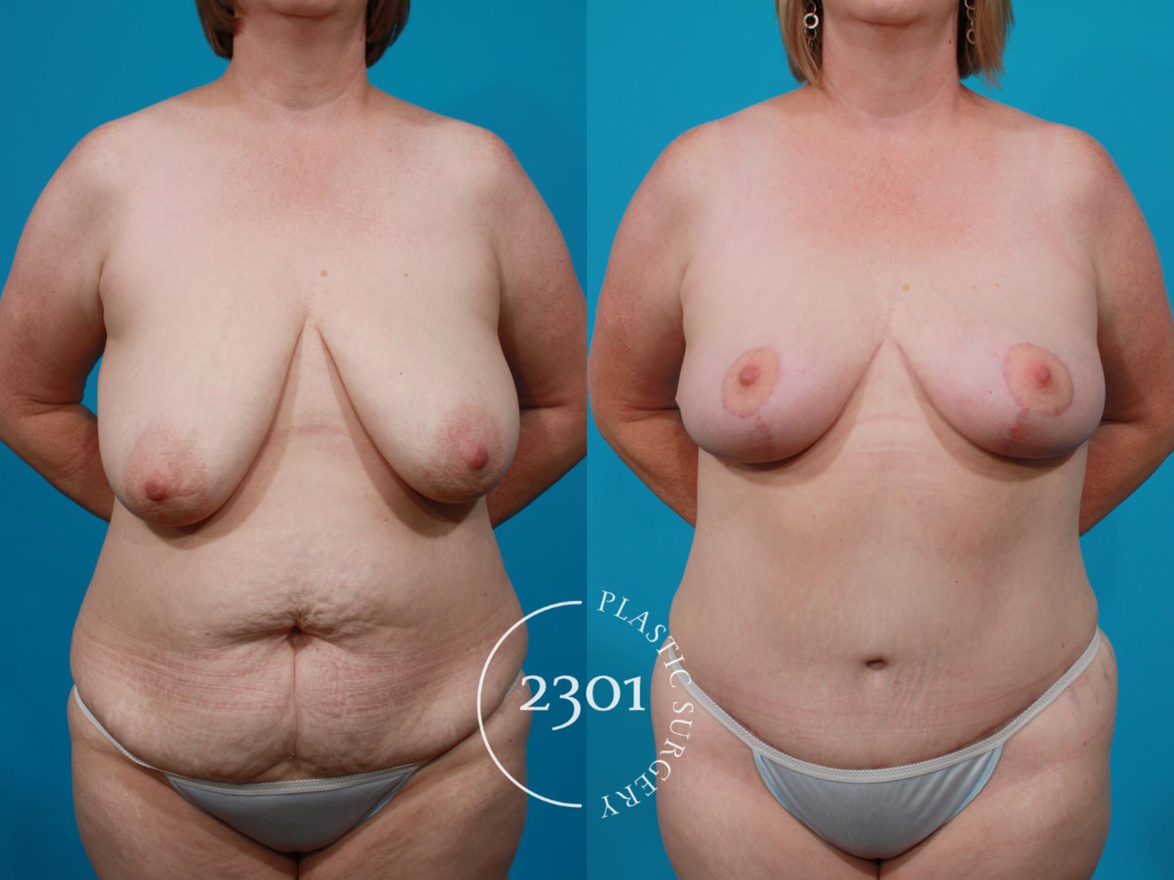 Before & After Breast Lift (Mastopexy) Case 145 View #1 View in Fort Worth, Plano, & Frisco, Texas