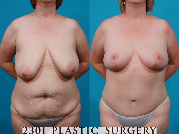 Before & After Breast Lift (Mastopexy) Case 145 View #1 View in Fort Worth, Plano, & Frisco, Texas