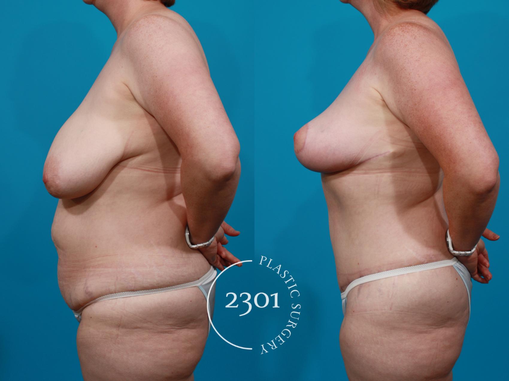 Before & After Breast Lift (Mastopexy) Case 145 View #2 View in Fort Worth, Plano, & Frisco, Texas