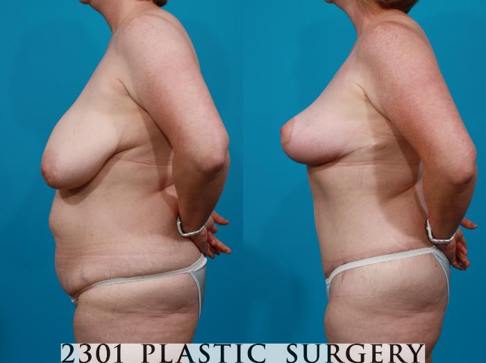 Before & After Breast Lift (Mastopexy) Case 145 View #2 View in Fort Worth, Plano, & Frisco, Texas