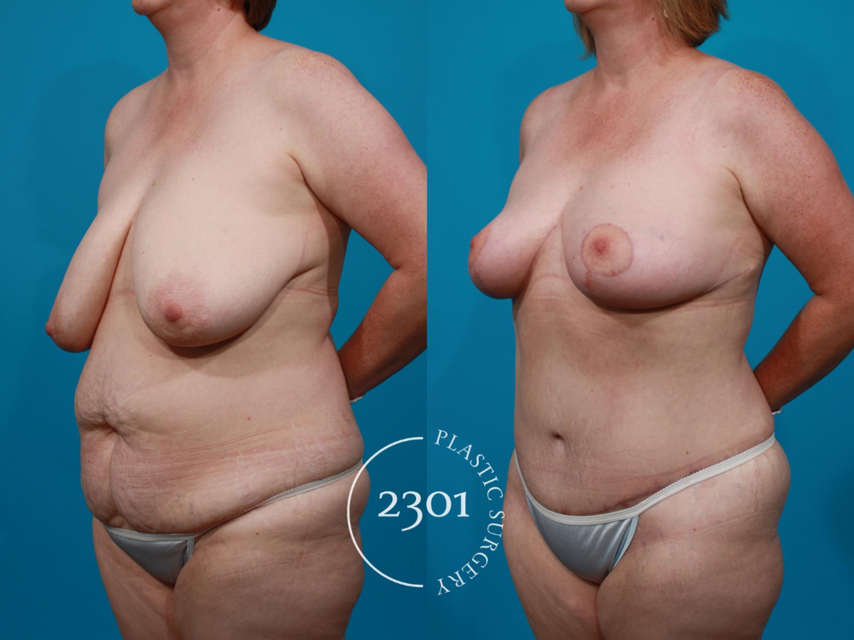 Before & After Breast Lift (Mastopexy) Case 145 View #3 View in Fort Worth, Plano, & Frisco, Texas