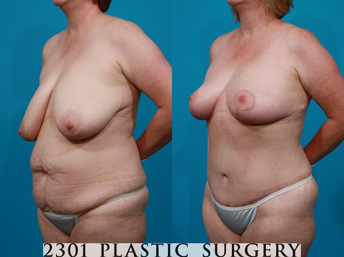 Before & After Mommy Makeover Case 145 View #3 View in Fort Worth, Plano, & Frisco, Texas