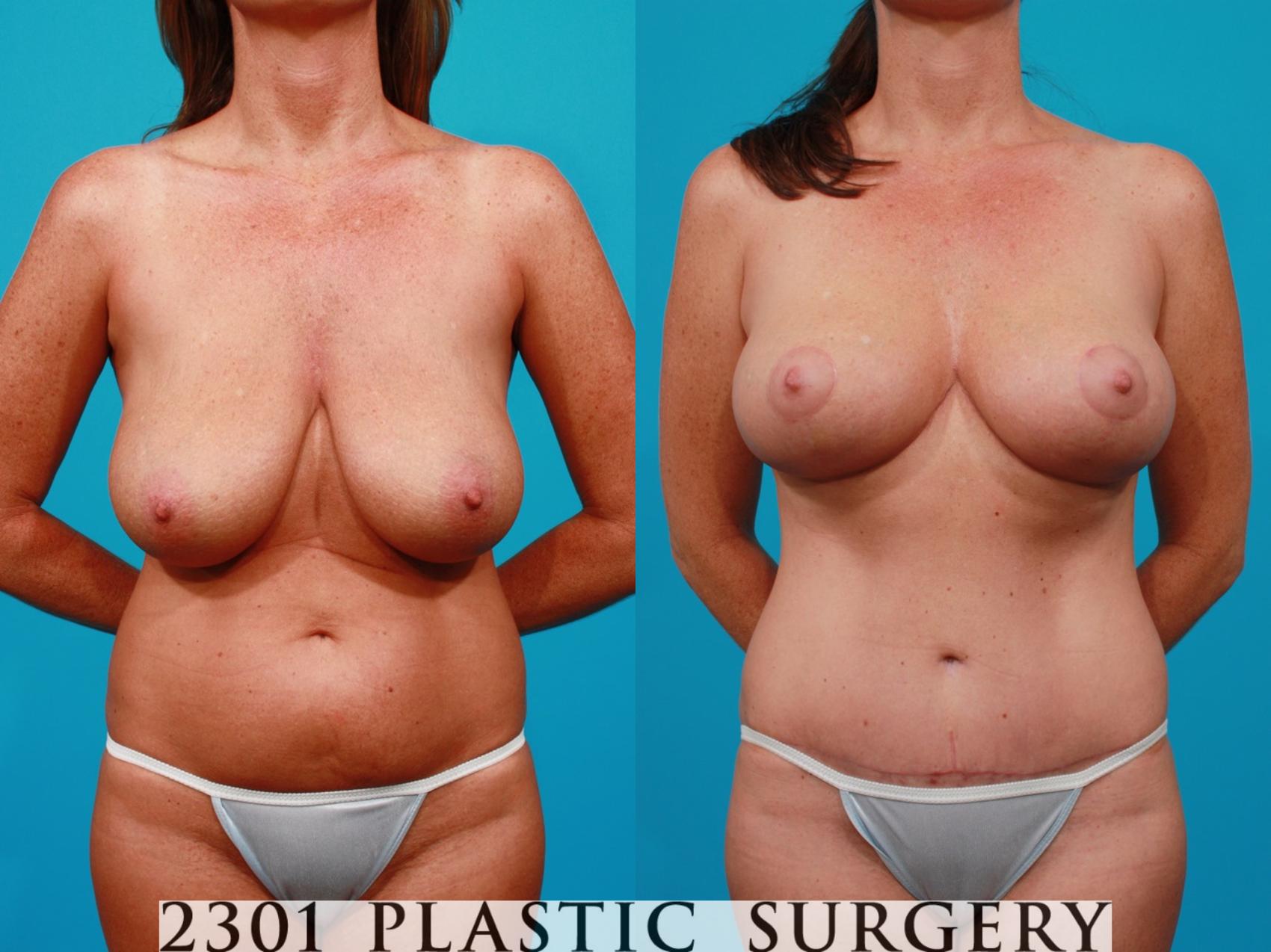 Before & After Breast Lift (Mastopexy) Case 151 View #1 View in Fort Worth & Frisco, Texas