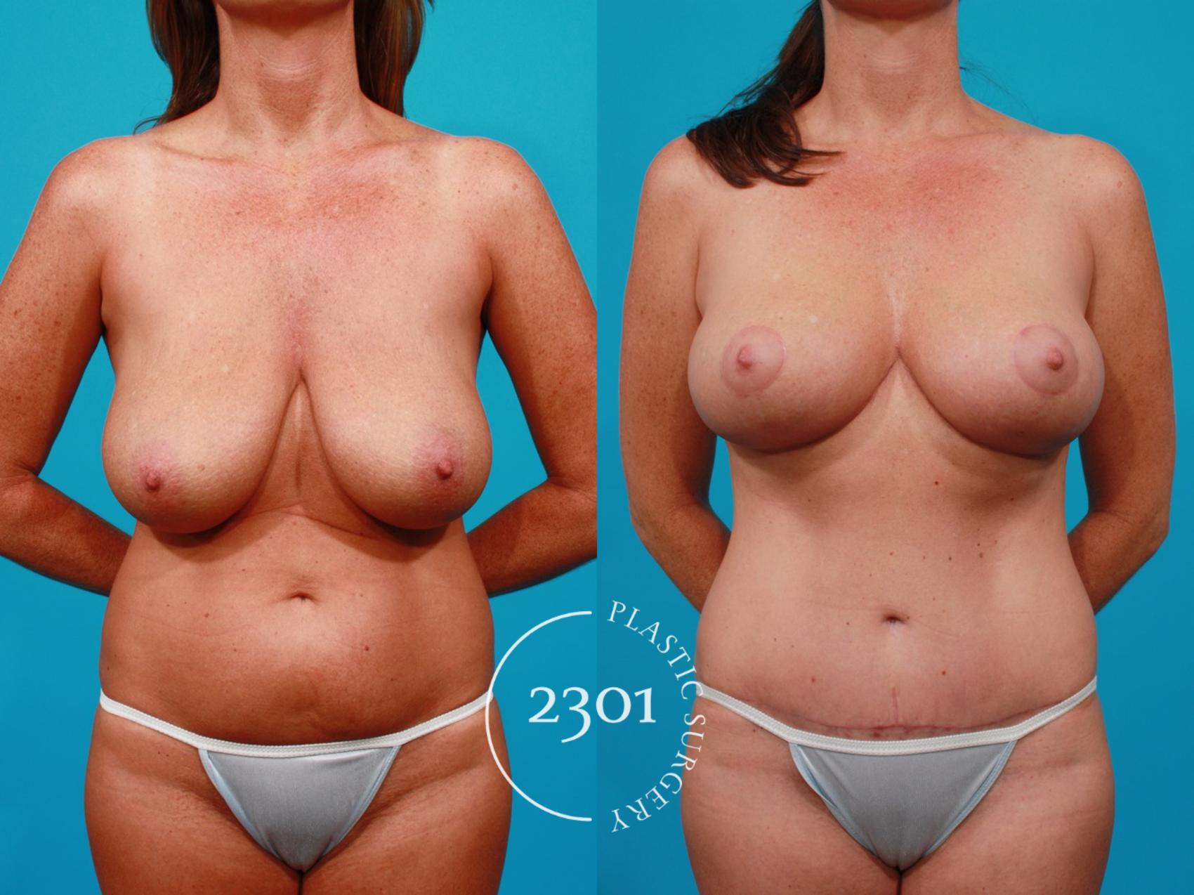 Before & After Tummy Tuck Case 151 View #1 View in Fort Worth, Plano, & Frisco, Texas