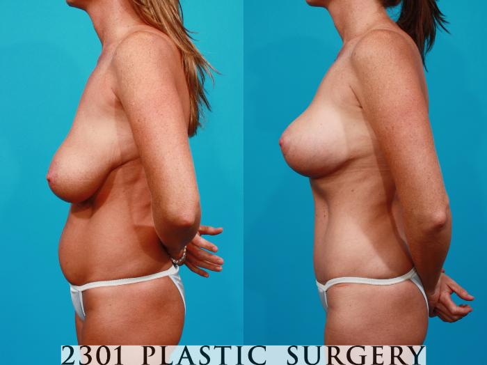 Before & After Breast Lift (Mastopexy) Case 151 View #2 View in Fort Worth, Plano, & Frisco, Texas