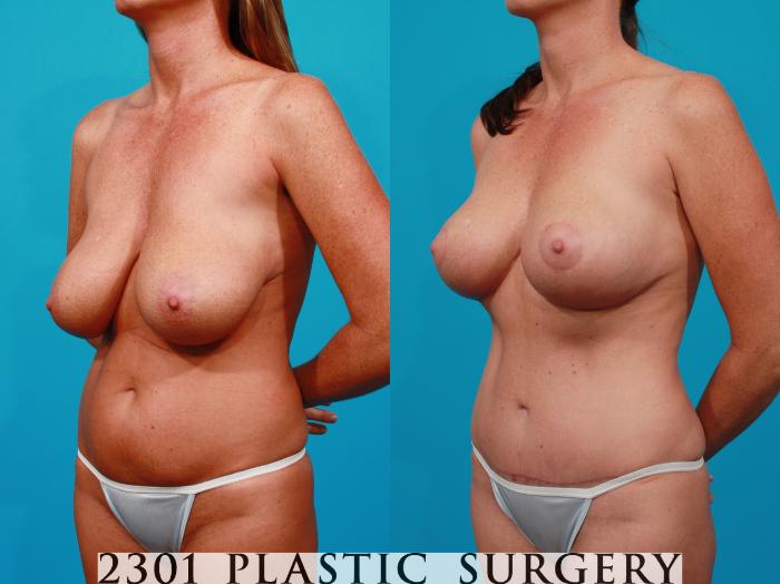 Before & After Tummy Tuck Case 151 View #3 View in Fort Worth, Plano, & Frisco, Texas