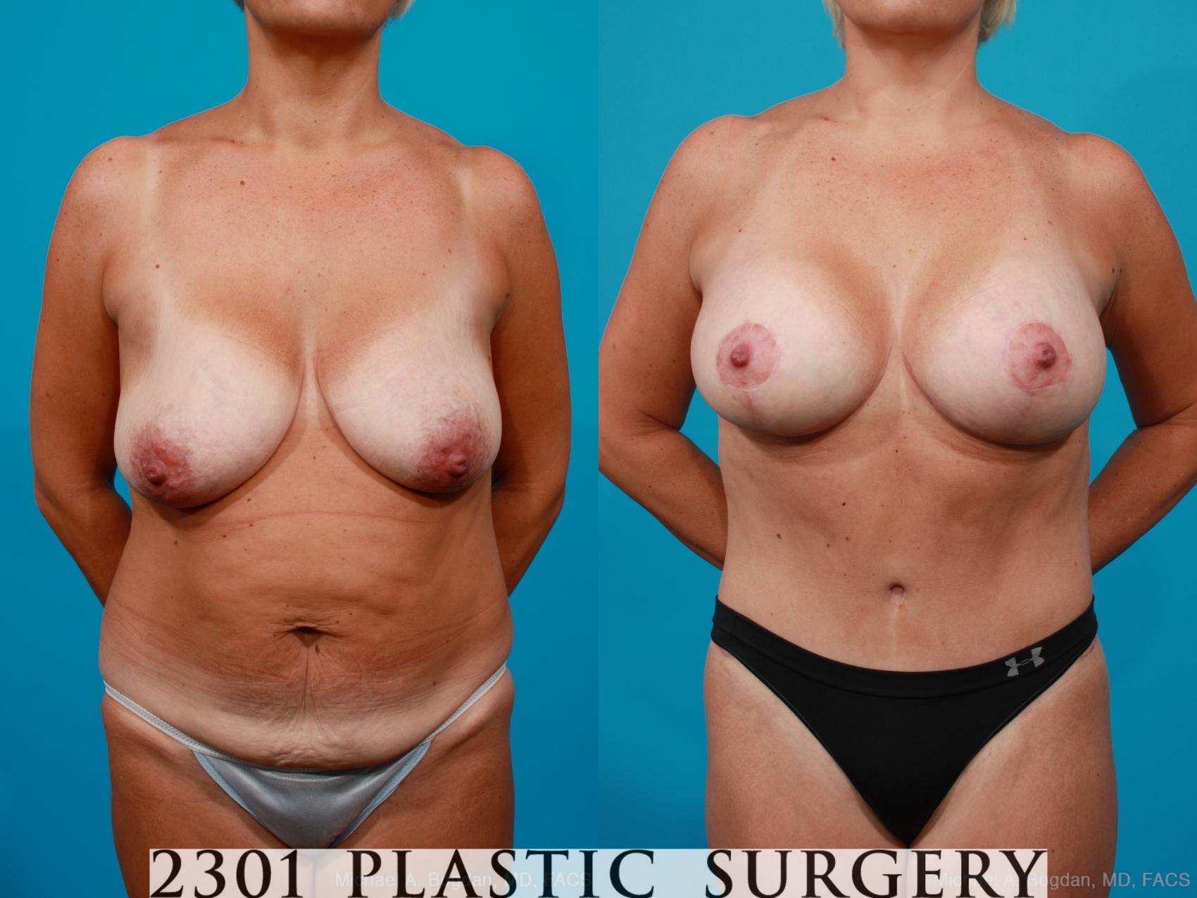 Before & After Breast Lift (Mastopexy) Case 158 View #1 View in Fort Worth & Frisco, Texas