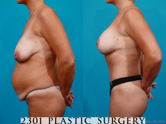 Before & After Breast Lift (Mastopexy) Case 158 View #2 View in Fort Worth, Plano, & Frisco, Texas